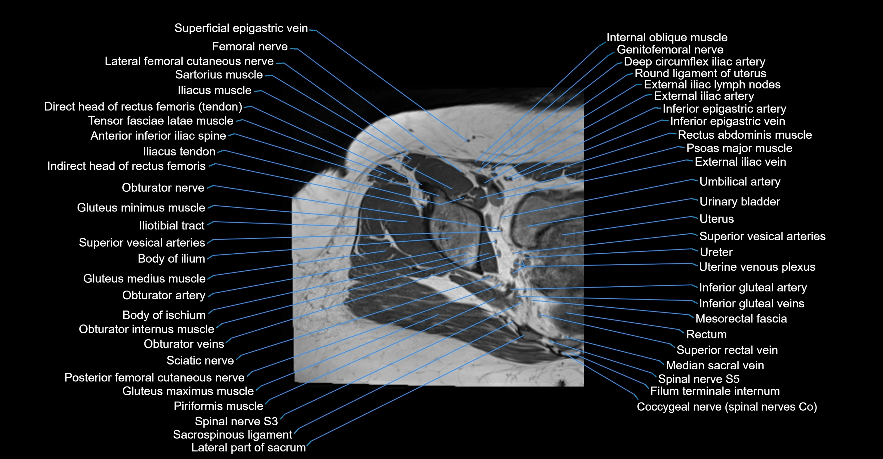 MRI hip axial cross sectional anatomy 3T 3D  radiology  anatomy image-img-00001-00024.webp